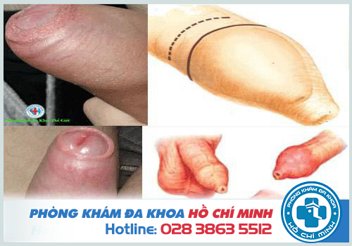 Hình ảnh dài và hẹp bao quy đầu ở người lớn.
