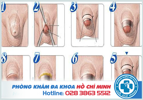hình ảnh hẹp bao quy đầu