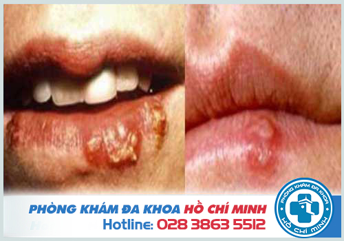 Hình ảnh vết bệnh Herpes ở miệng