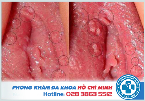 Mụn ở vùng kín là triệu chứng của nhiều bệnh lý lây chủ yếu qua đường tình dục
