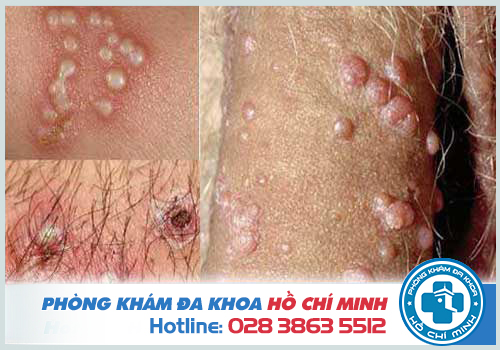 Hình ảnh mụn rộp sinh dục