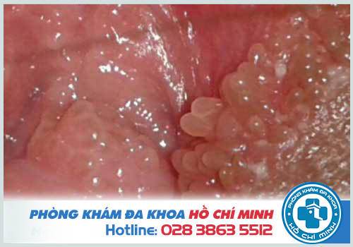 Hình ảnh mụn gai sinh dục
