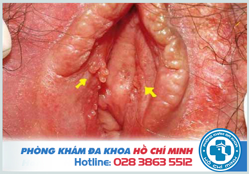 Hình ảnh sùi mào gà vùng kín