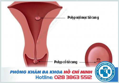 Hình ảnh polyp cổ tử cung ở chị em phụ nữ