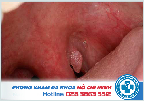 Hình ảnh sùi mào gà ở họng giai đoạn đầu