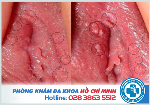 Hình ảnh bệnh sùi mào gà giai đoạn đầu ở nữ