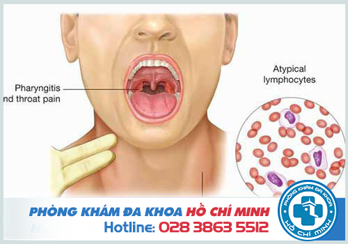 Virus EBV làm tăng nguy cơ mắc bệnh ung thư vòm họng