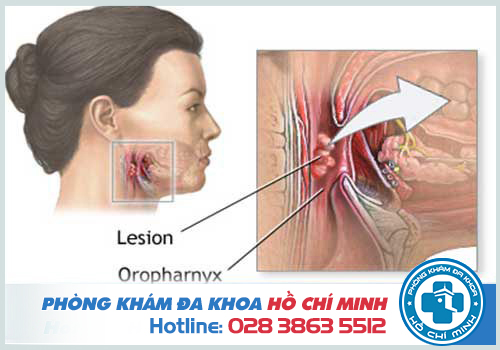 Hình ảnh ung thư vòm họng giai đoạn cuối khiến người bệnh mất tiếng