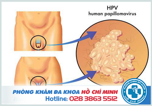 Bị nhiễm HPV có nguy hiểm không