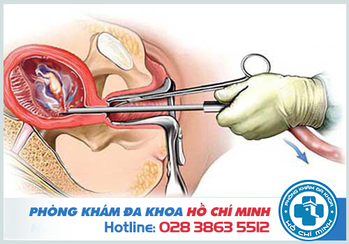 Hút thai có đau không? Chi phí và quy trình nạo hút thai an toàn