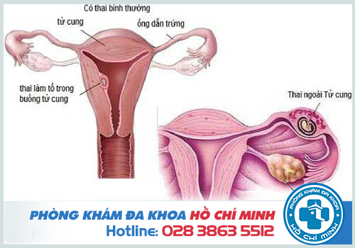 Viêm vùng chậu gây ra mang thai ngoài tử cung