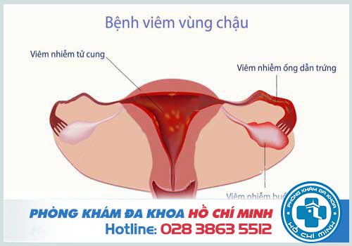 Bệnh viêm vùng chậu là bệnh hay gặp ở phụ nữ