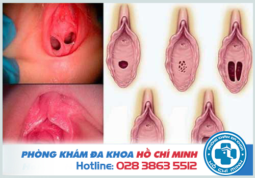 Hình ảnh màng trinh ở nữ giới