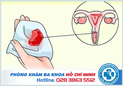 Kinh nguyệt kéo dài hơn 2 tuần là bị gì