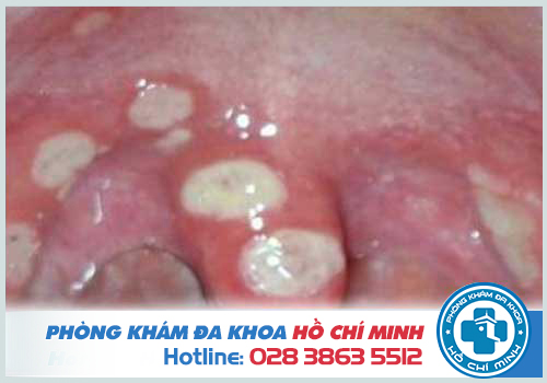 Lưỡi gà bị loét có nguy hiểm không? Cách chữa