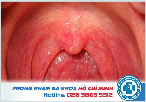 Lưỡi gà là phần nhỏ nhô ra phía ngoài