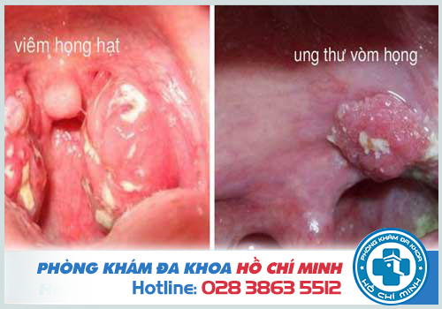 Viêm loét lưỡi gà có thể là dấu hiệu sớm của ung thư vòm họng