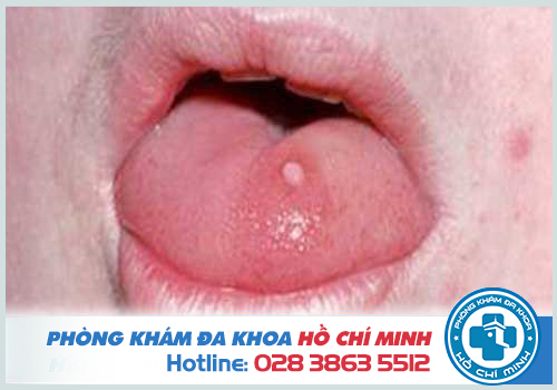 Lưỡi nổi mụn thịt đỏ là do bệnh u nhú tiền đình Papillomatosis