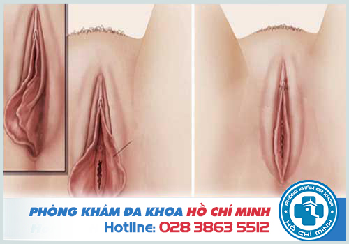 Màng trinh nằm cách cửa âm đạo khoảng 2-3cm vào bên trong