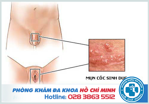 Mụn cóc sinh dục có nguy hiểm không? Cách chữa