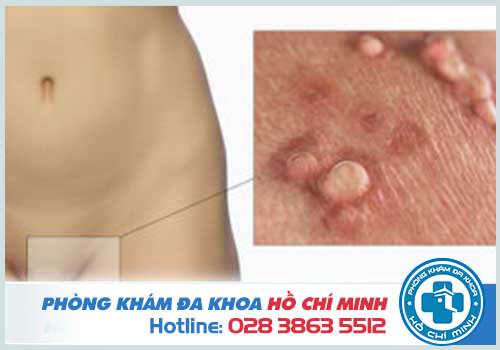 Mụn cóc sinh dục có nguy hiểm không và Cách chữa