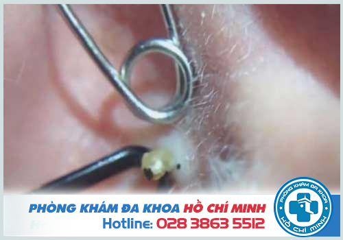 Mụn mủ trong tai là bị bệnh gì? Cách điều trị tốt nhất