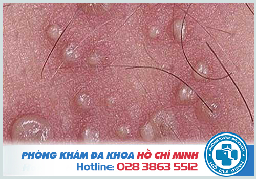 Nổi mụn nước ở vùng kín nam và nữ là bị gì? Cách chữa trị