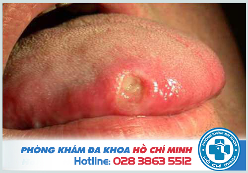 Triệu chứng của bệnh mụn rộp sinh dục ở lưỡi