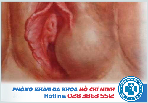 Nổi hạch ở vùng kín nữ không đau do u nang tuyến Bartholin