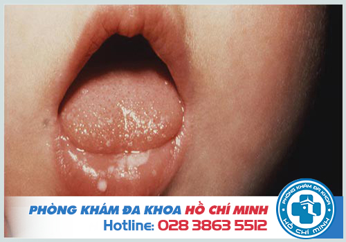 Chữa trị nổi nốt trắng trong khoang miệng như thế nào