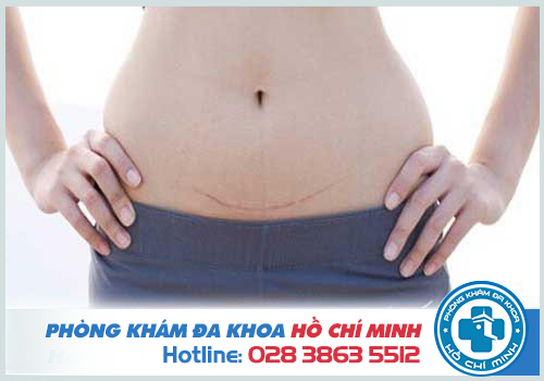 Phá thai bằng thuốc sau khi sinh mổ có được không?