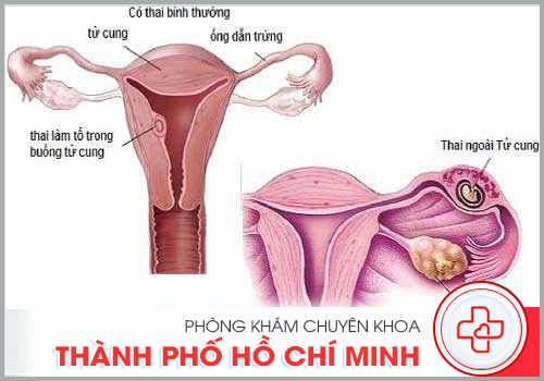 Phá thai do thai nhi ngoài tử cung