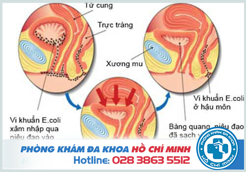 Nhiễm trùng đường tiểu gây ra nhiều biến chứng nguy hiểm