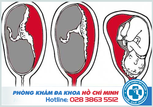 bệnh viện phá thai ở Hóc Môn uy tín an toàn