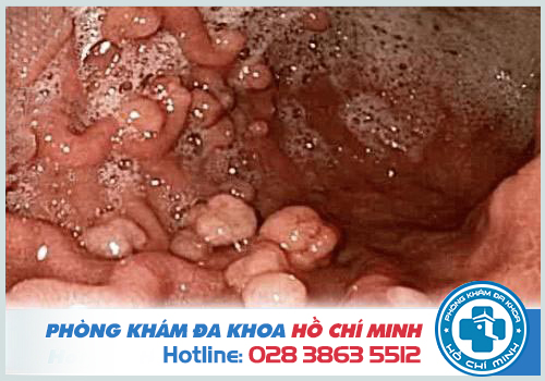 Bệnh polyb âm đạo có nguy hiểm không