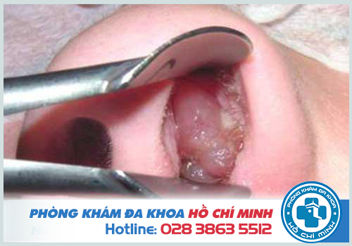 Polyp xoang hàm gây tác ngạt mũi nghiêm trọng