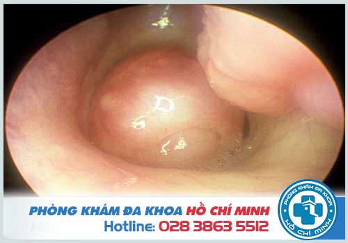 Polyp xoang hàm làm tổn thương các cơ quan lân cận