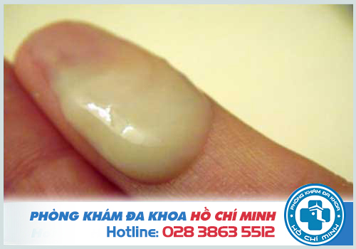 Ra khí hư màu vàng nhưng không ngứa thì có sao không