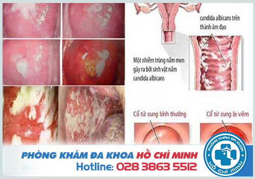 Ra khí hư màu vàng nhưng không ngứa có thể do viêm âm đạo