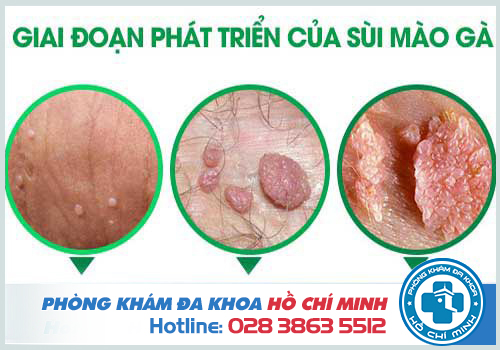 Nổi mụn nước ở vùng kín nam
