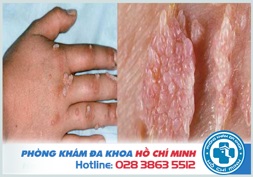 Bệnh sùi mào gà ở tay có biểu hiện gì