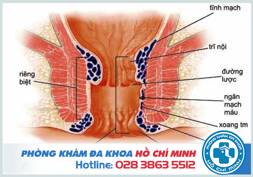 Bệnh trĩ hỗn hợp là kết hợp giữ trĩ nội và ngoại