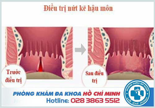 Điều trị nứt kẽ hậu môn kịp thời giúp tránh được các biến chứng nguy hiểm