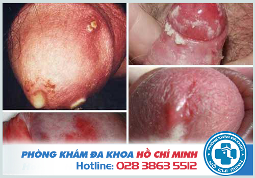 Thuốc chữa bệnh lậu