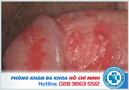 Thuốc chữa bệnh mụn rộp sinh dục hiệu quả