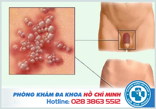 Thuốc chữa bệnh mụn rộp sinh dục hiệu quả nhất