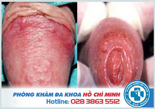 Thuốc chữa viêm nhiễm bao quy đầu tốt