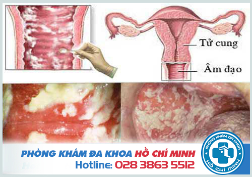 Thuốc chữa trị viêm âm đạo hiệu quả nhất