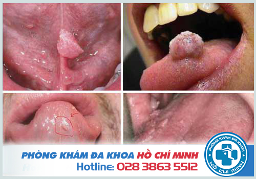 Thuốc uống chữa trị sùi mào gà