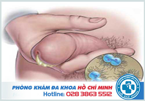 Tiểu đau buốt sau khi quan hệ